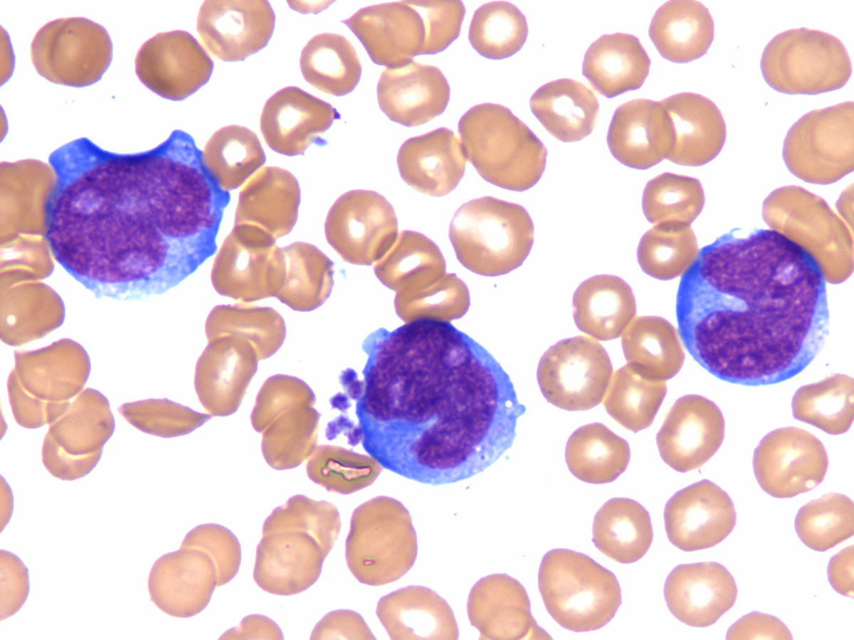 The aspirate smear shows increased blasts. Some blasts have monocytic differentiation (Wright-Giemsa, 1000x).